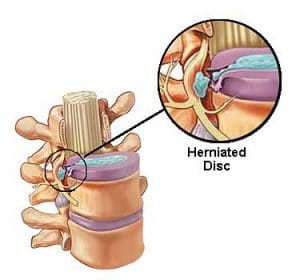 Spinal Decompression